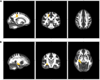 Altered White Matter Integrity at Illness Onset in Adolescents With a First Episode of Psychosis